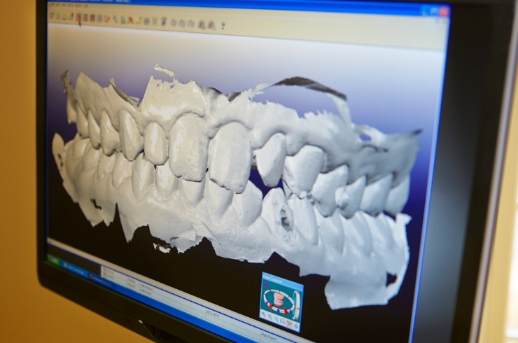 Digital Intraoral Scanning image