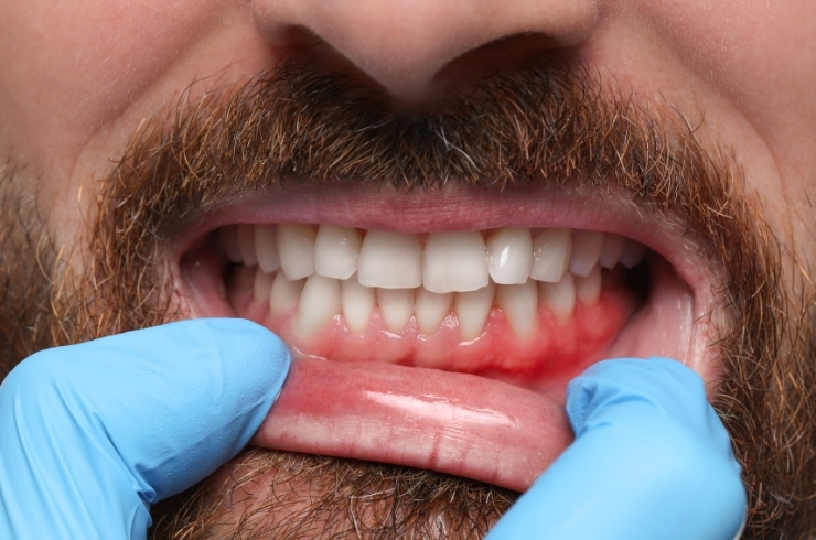 Gum Disease Treatment image