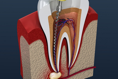 Root Canal Treatment image