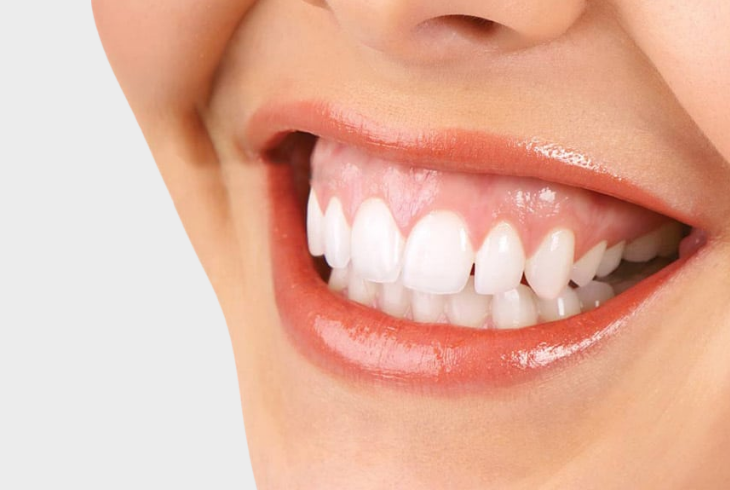 gummy smile-image
